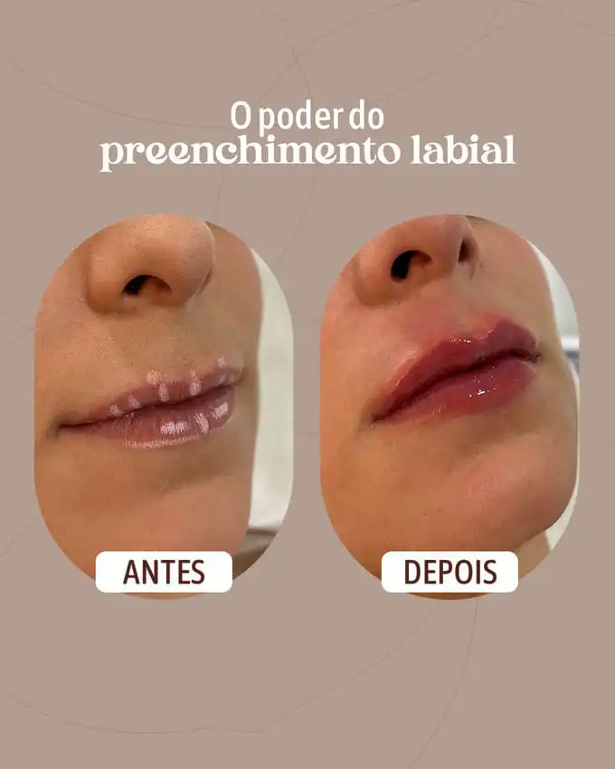 Antes e Depois preenchimento labial na clinica de estética em joão pessoa pb