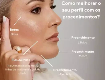 Harmonização Facial na clinica de estética Camila Lima em João Pessoa PB